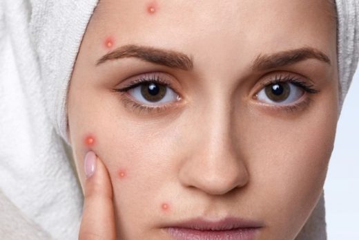 Easy and Proven Ways to Get Rid of Pimples Fast