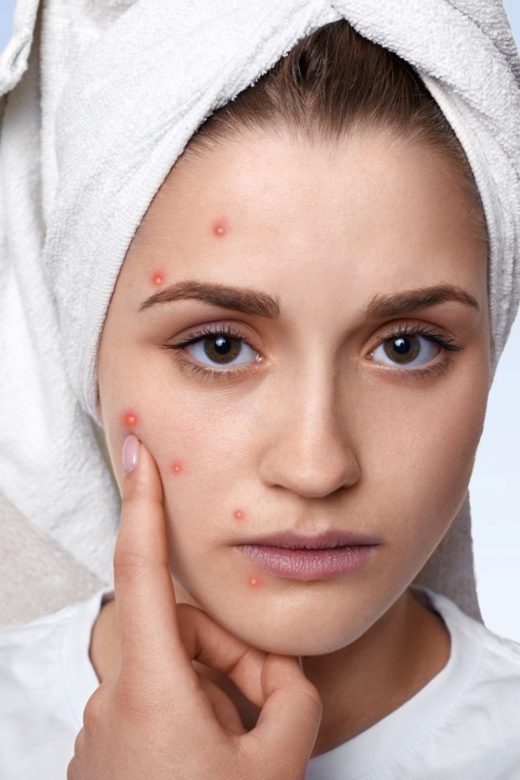 Easy and Proven Ways to Get Rid of Pimples Fast