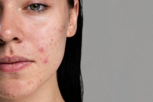 The Solution To Acne Spots Mask At Home