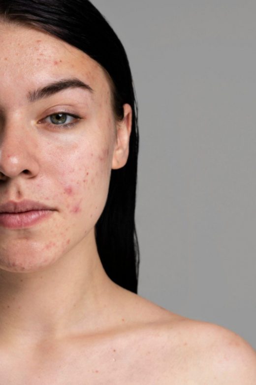 The Solution To Acne Spots Mask At Home