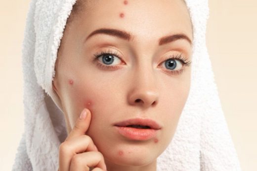 The Ultimate Solution For Acne Spots