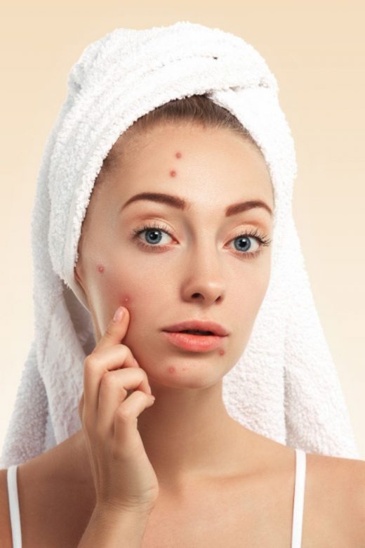 The Ultimate Solution For Acne Spots